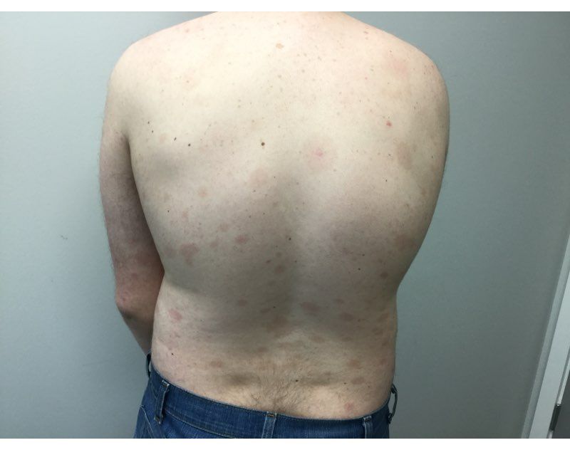 Psoriasis After  Treatment 