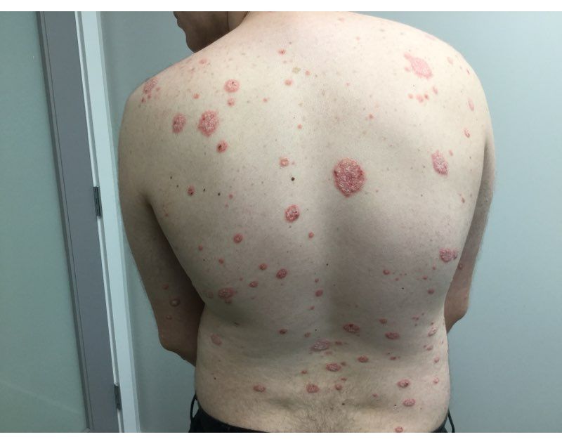 Psoriasis Before Treatment