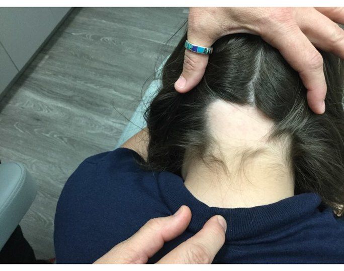 Alopecia Before Treatment 