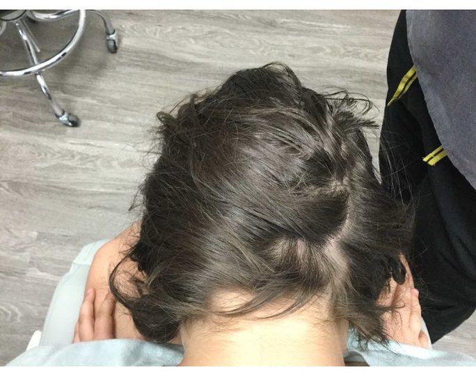 Alopecia After Treatment