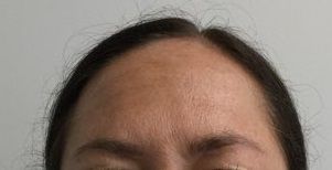 Botox After Treatment