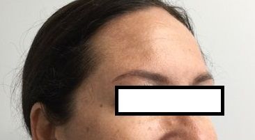 Botox After Treatment