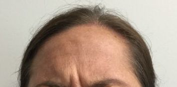 Before Botox Treatment