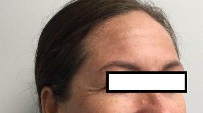 Before Botox Treatment