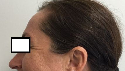 Before Botox Treatment