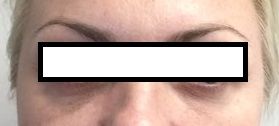 Fillers After