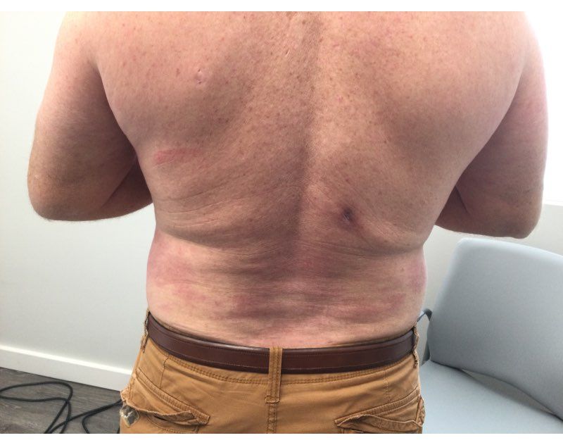 Psoriasis After Treatment