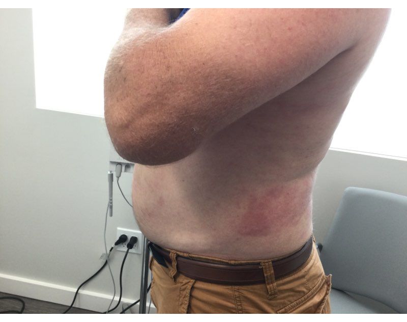 Psoriasis After Treatment
