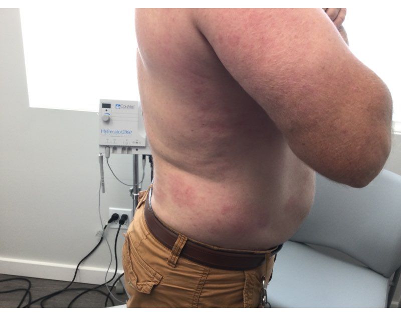 Psoriasis After Treatment