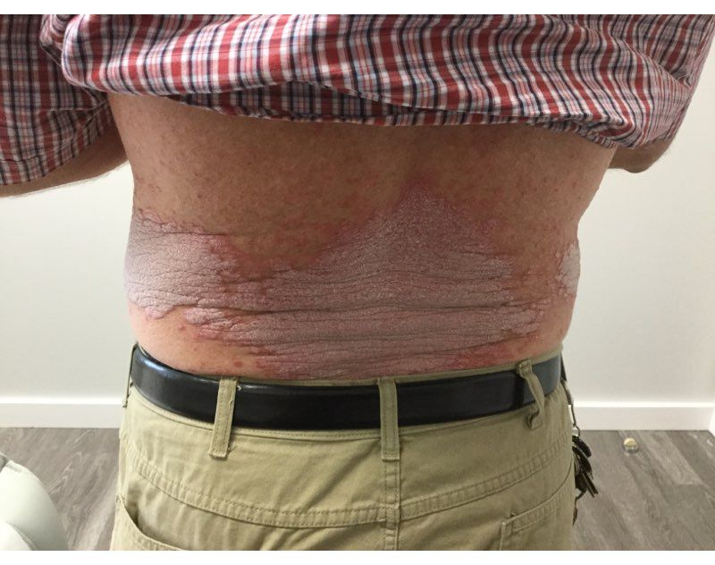 Psoriasis Before Treatment