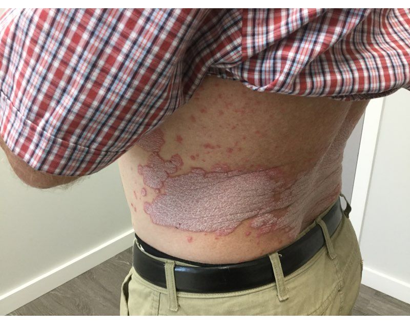 Psoriasis Before Treatment
