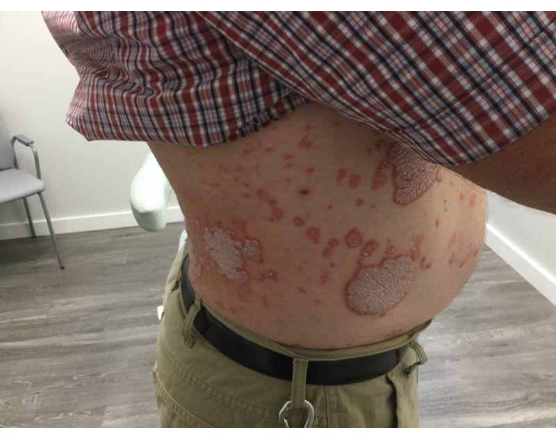 Psoriasis Before Treatment