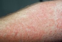 contact dermatitis