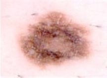 Dysplastic Nevus