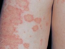 eczema leg