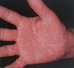 hand with eczema