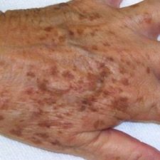 hand with liver spots