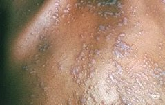 lichen planus