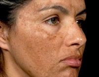 melasma