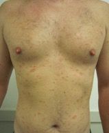 Pityriasis