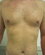 Pityriasis