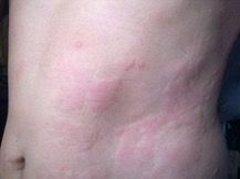 Urticaria