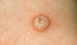 warts
