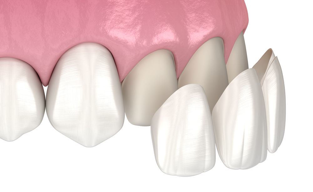 Composite Bonding: The Versatile Solution for Cosmetic Dental Concerns