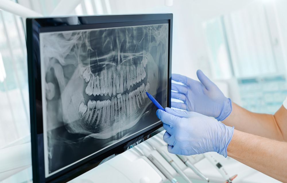 Understanding Dental X-rays and Why They Are Necessary