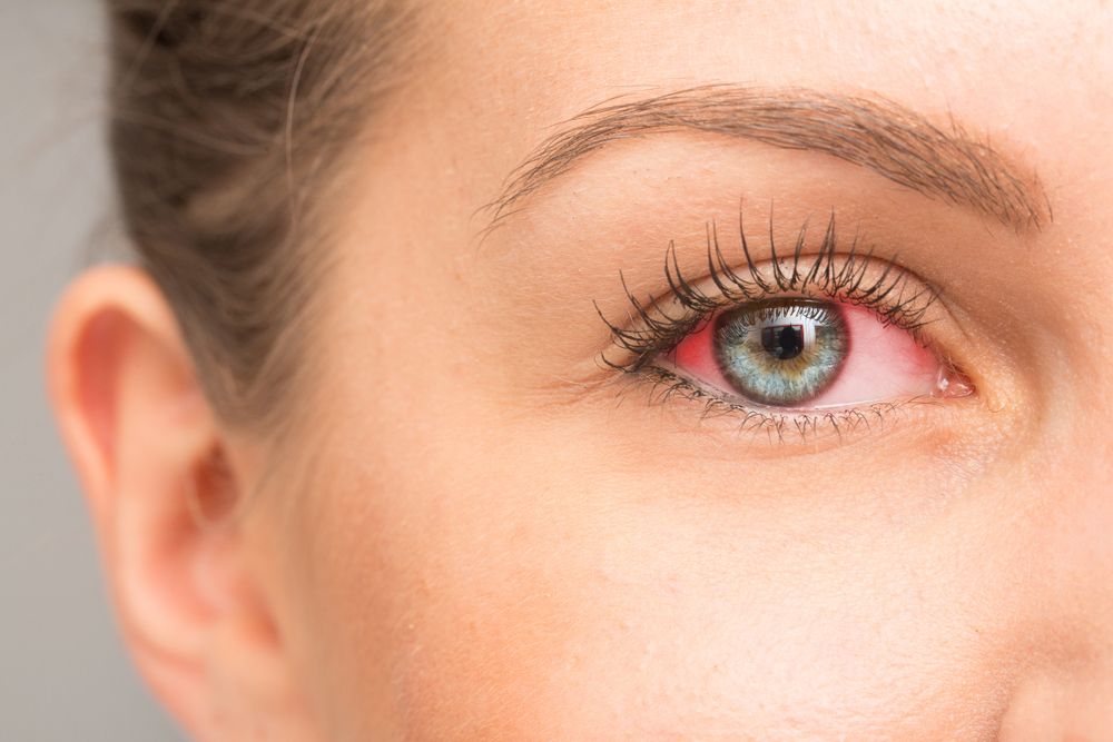 Understanding Eye Allergies: Causes, Symptoms, and Treatment Options