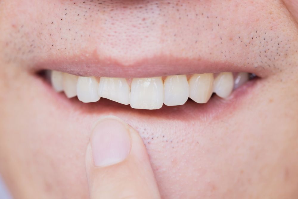 Don't Panic! Your Options for a Chipped Tooth