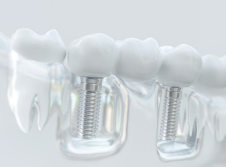 The Benefits of Dental Implants