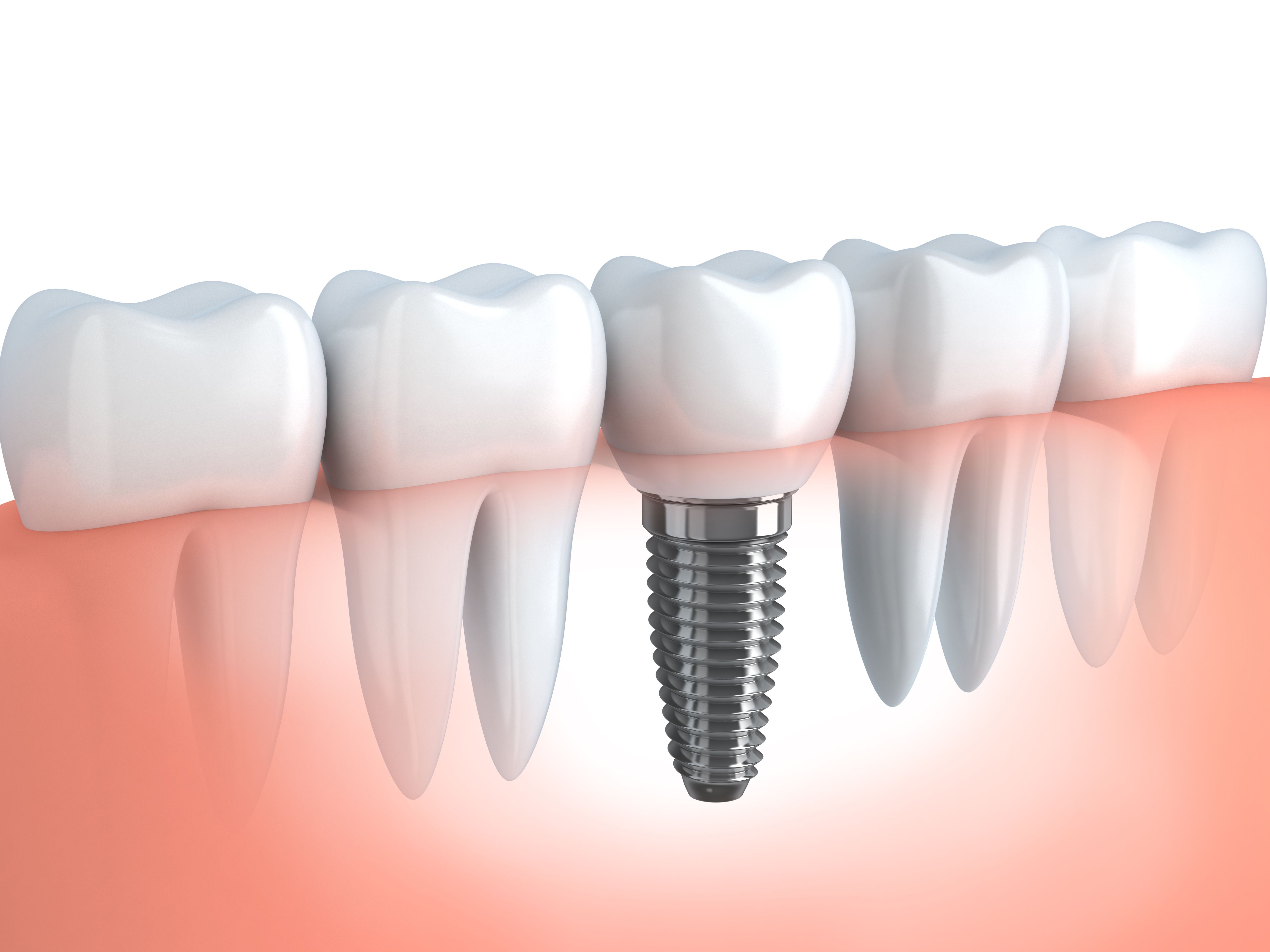 Single tooth implant