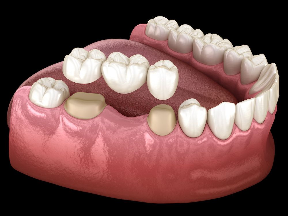 What Is a Dental Bridge?