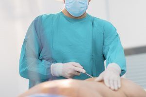 What No One Tells You About Liposuction
