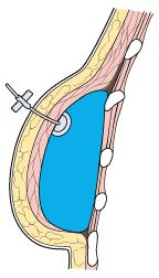 breast illustration