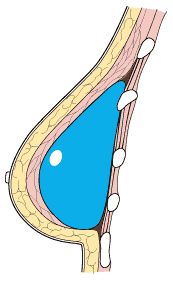 breast illustration