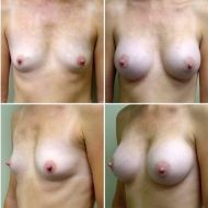 before and after breast augmentation