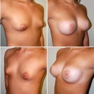 before and after breast lift