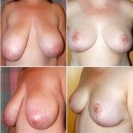 breast reduction gallery