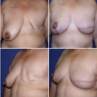 before and after breast reconstruction