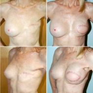 lattisimus flap breast reconstruction