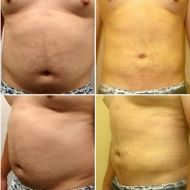 Liposuction in San Diego