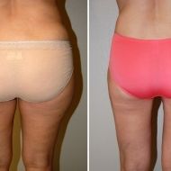 liposuction before and after