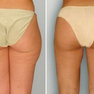 liposuction