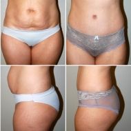 Tummy Tuck Before & After