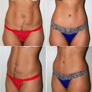 tummy tuck before and after