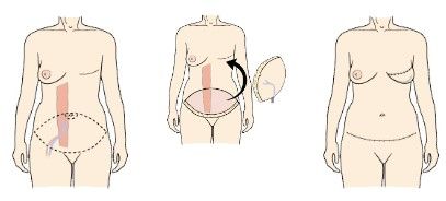 before and after diep flap