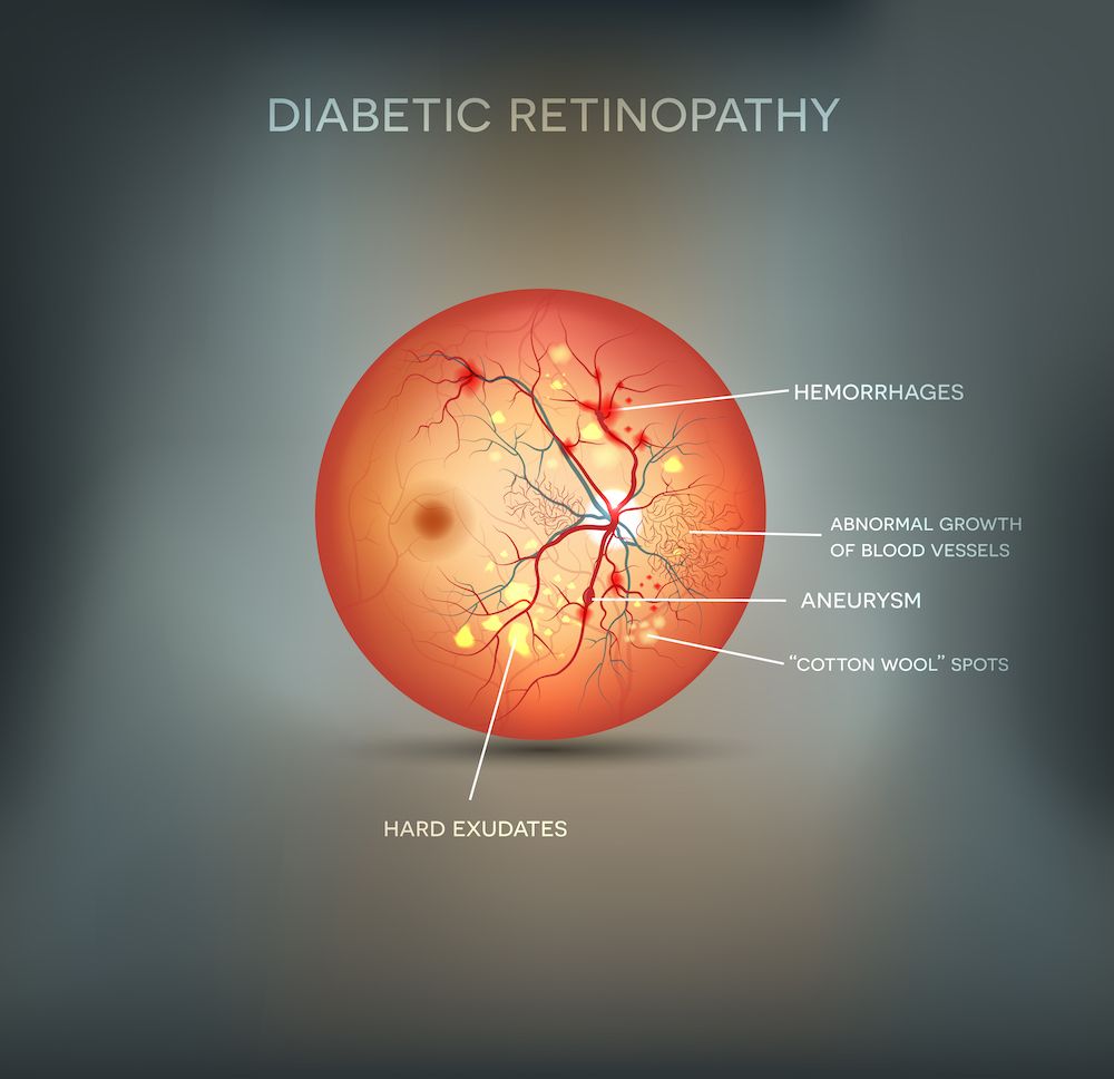 Diabetes and the Eye