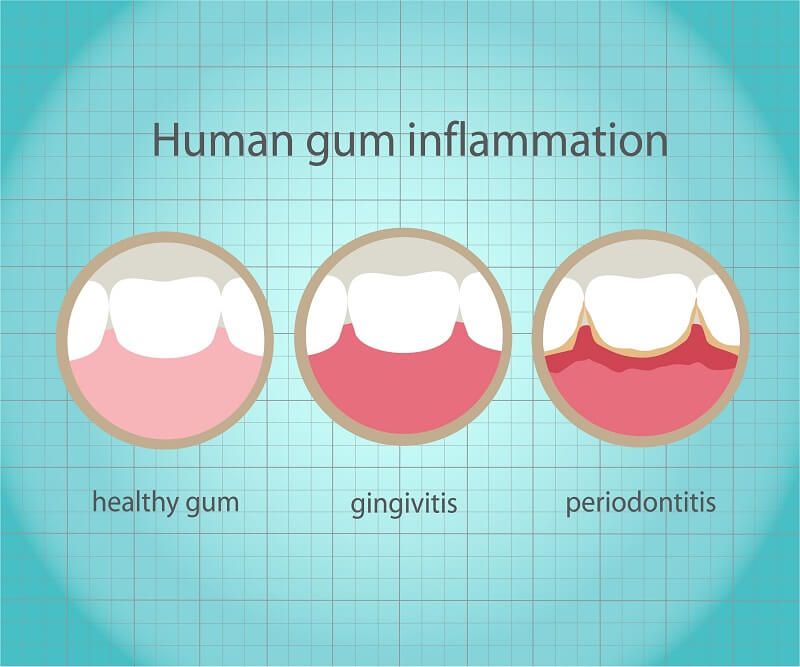 Signs and Symptoms of Your Gums That You Shouldn’t Ignore